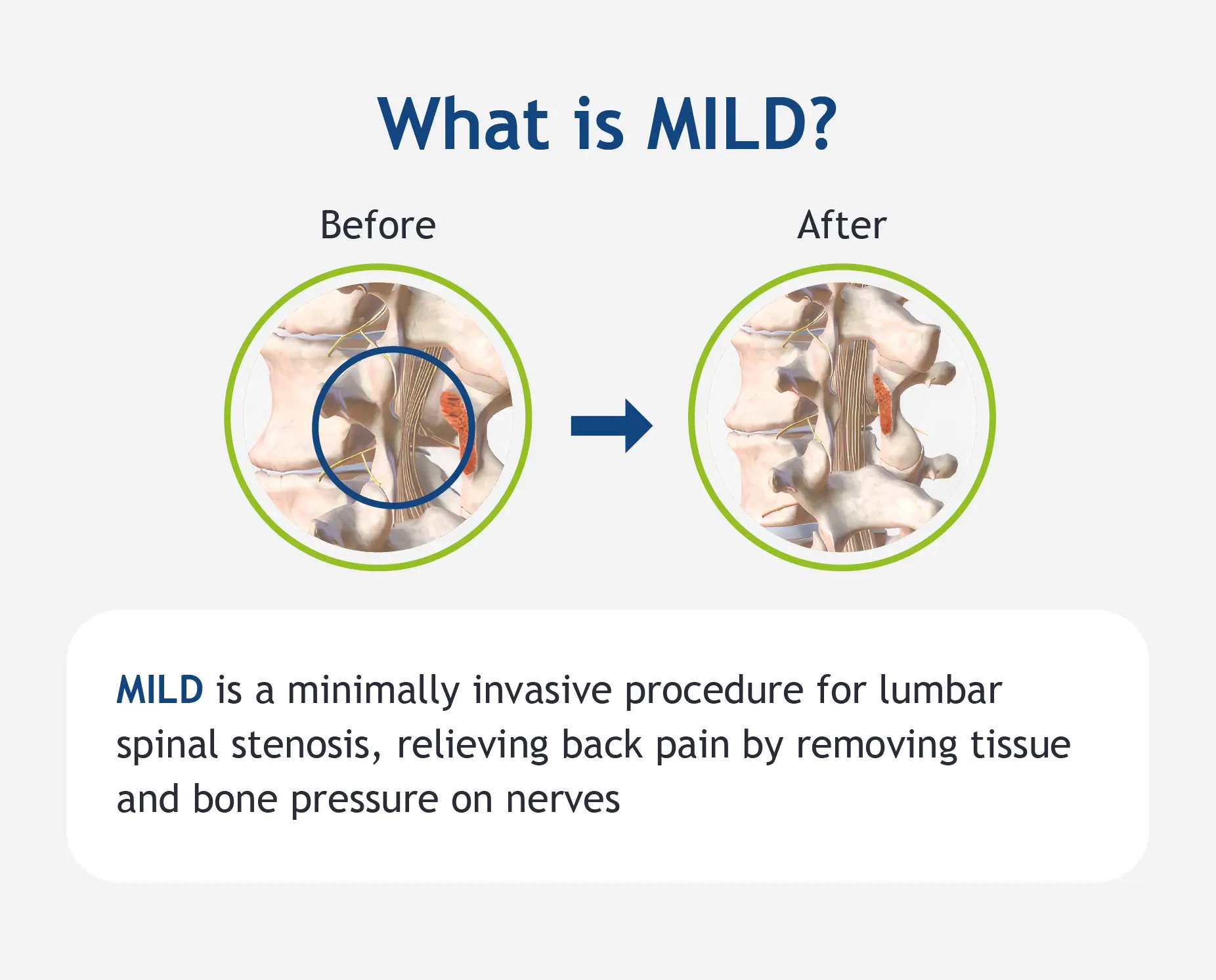 An infographic defining the MILD procedure.